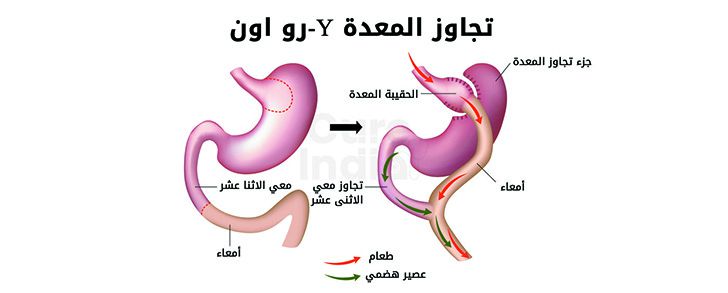 تجاوز المعدة بالمنظار